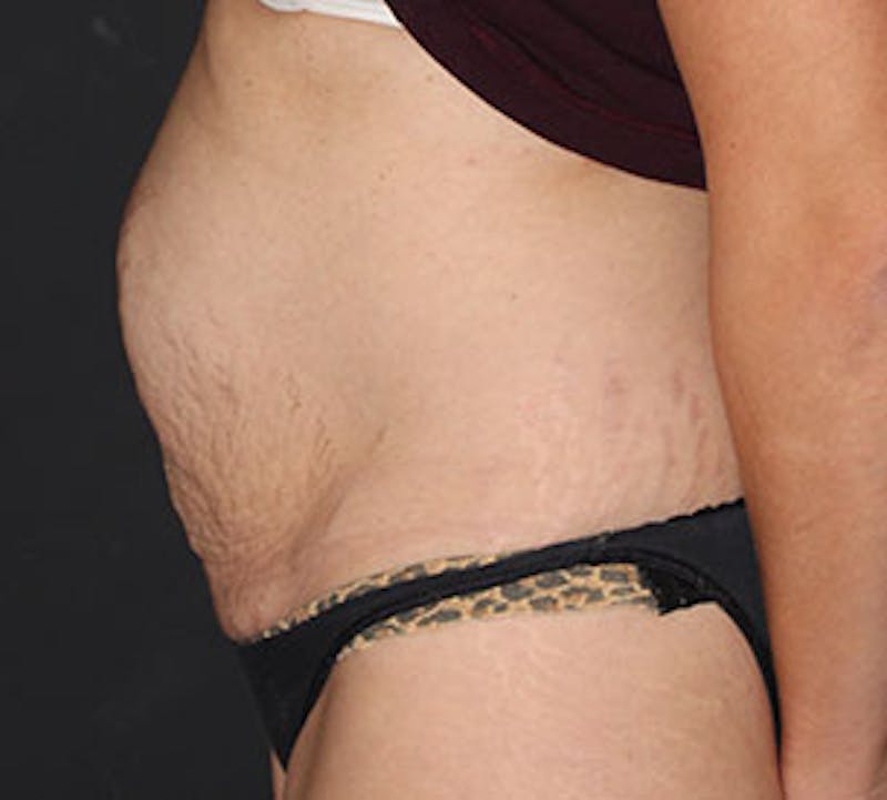 Abdominoplasty (Tummy Tuck) Before & After Gallery - Patient 106984811 - Image 9