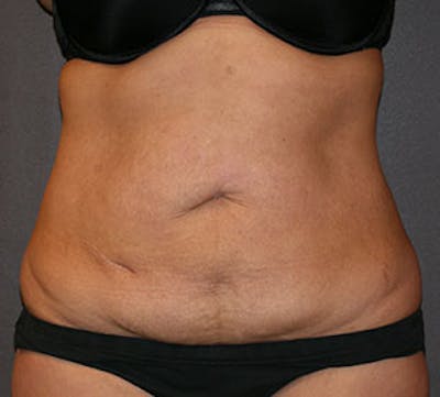 Abdominoplasty (Tummy Tuck) Before & After Gallery - Patient 106984866 - Image 1