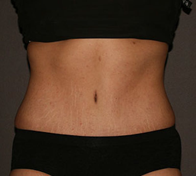 Abdominoplasty (Tummy Tuck) Before & After Gallery - Patient 106984866 - Image 2