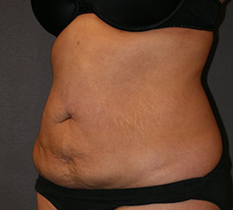 Abdominoplasty (Tummy Tuck) Before & After Gallery - Patient 106984866 - Image 5