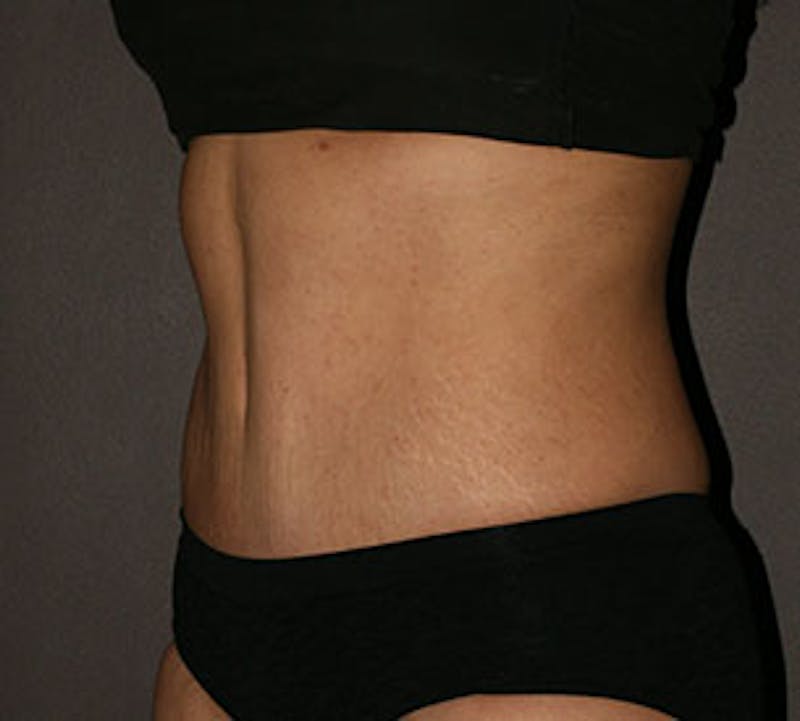 Abdominoplasty (Tummy Tuck) Before & After Gallery - Patient 106984866 - Image 6