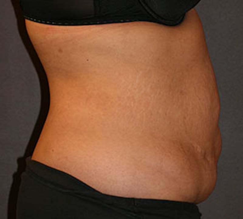 Abdominoplasty (Tummy Tuck) Before & After Gallery - Patient 106984866 - Image 7