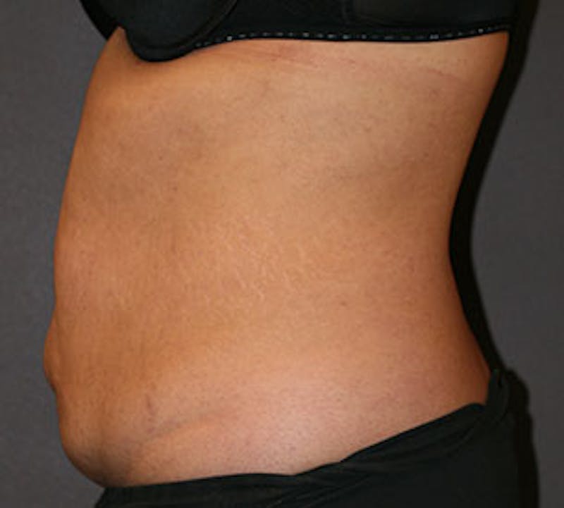 Abdominoplasty (Tummy Tuck) Before & After Gallery - Patient 106984866 - Image 9