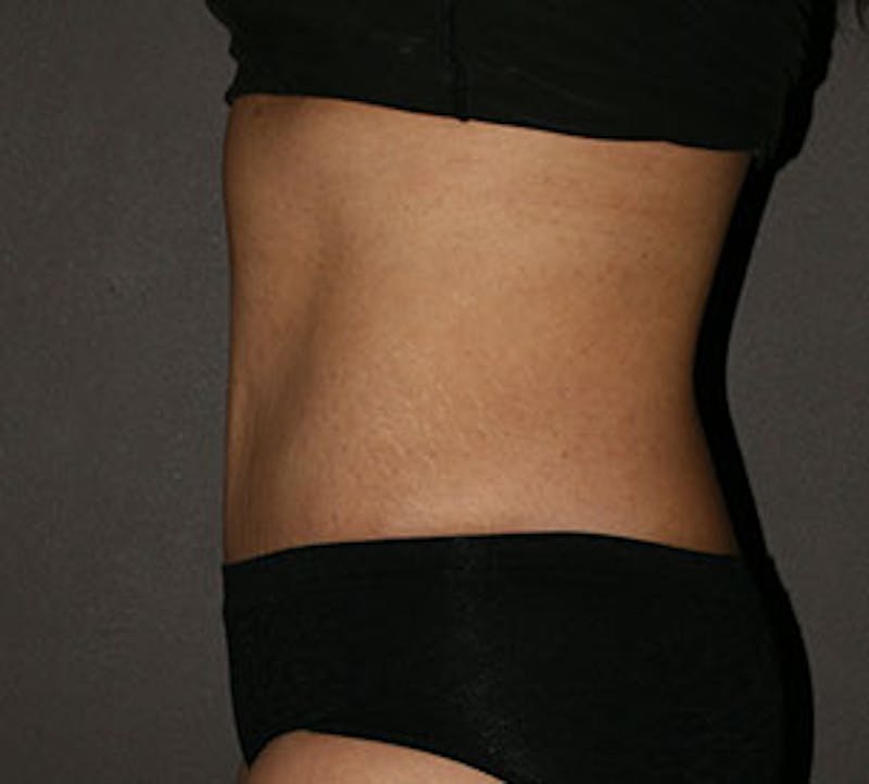 Abdominoplasty (Tummy Tuck) Before & After Gallery - Patient 106984866 - Image 10