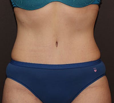 Abdominoplasty (Tummy Tuck) Before & After Gallery - Patient 106984873 - Image 2