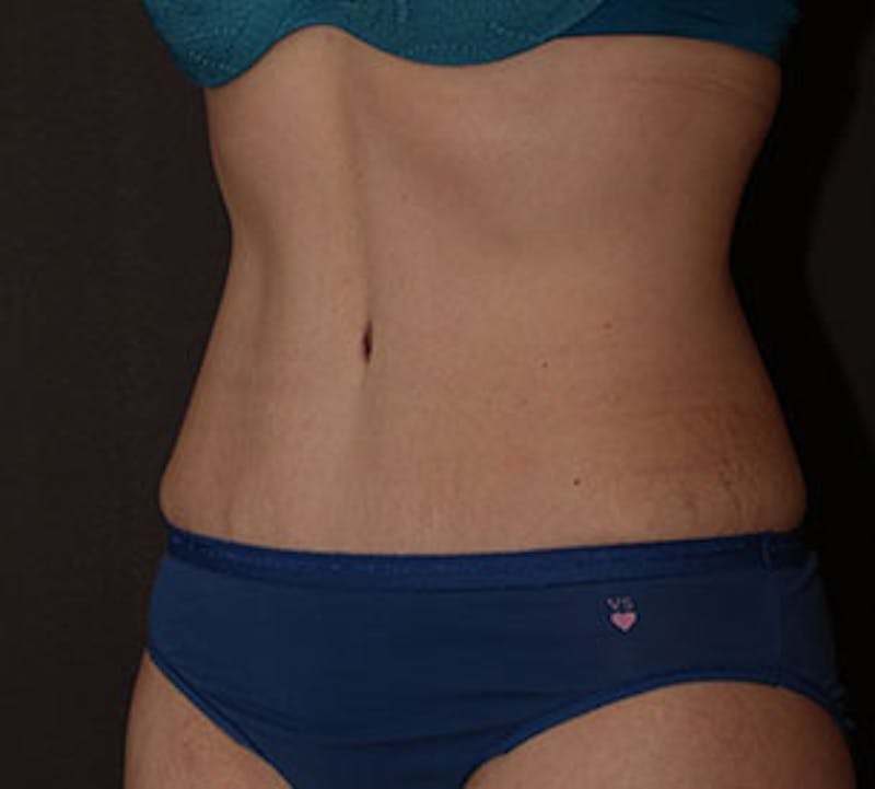 Abdominoplasty (Tummy Tuck) Before & After Gallery - Patient 106984873 - Image 4