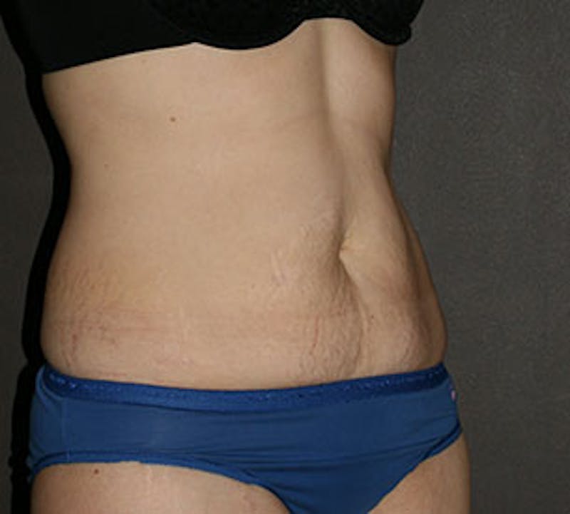 Abdominoplasty (Tummy Tuck) Before & After Gallery - Patient 106984873 - Image 5