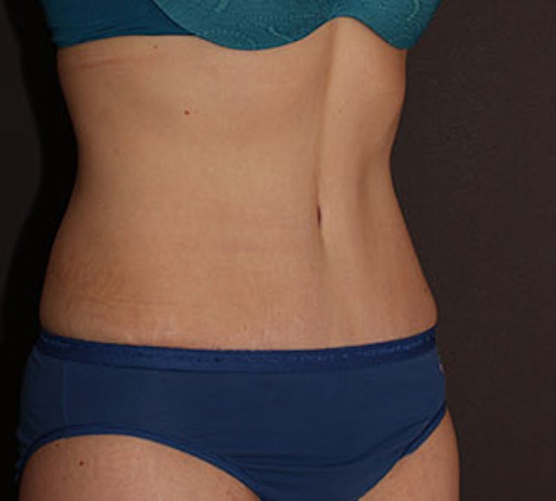 Abdominoplasty (Tummy Tuck) Before & After Gallery - Patient 106984873 - Image 6