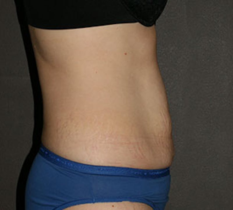 Abdominoplasty (Tummy Tuck) Before & After Gallery - Patient 106984873 - Image 9