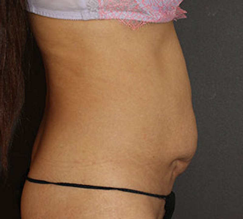 Abdominoplasty (Tummy Tuck) Before & After Gallery - Patient 106984909 - Image 9