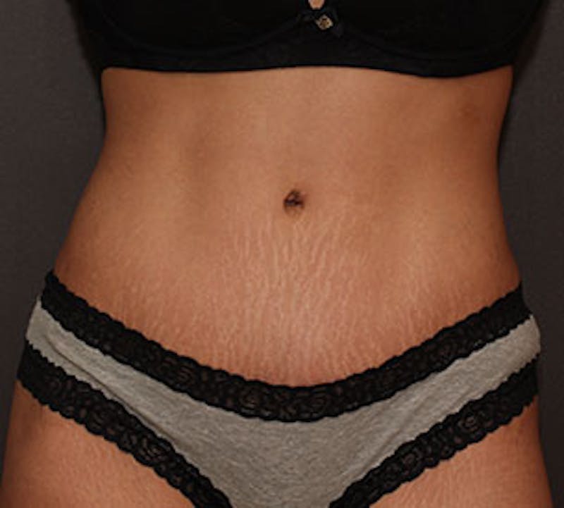 Abdominoplasty (Tummy Tuck) Before & After Gallery - Patient 106984924 - Image 2