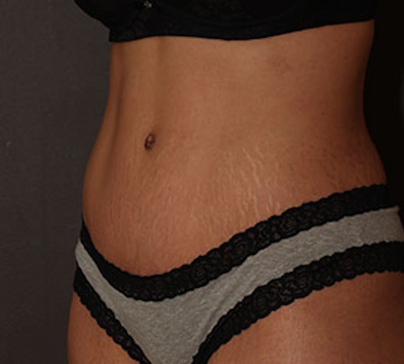 Abdominoplasty (Tummy Tuck) Before & After Gallery - Patient 106984924 - Image 4
