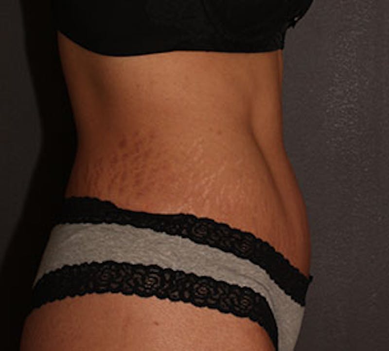 Abdominoplasty (Tummy Tuck) Before & After Gallery - Patient 106984924 - Image 10