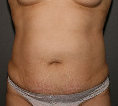 Abdominoplasty (Tummy Tuck) Before & After Gallery - Patient 106984934 - Image 1