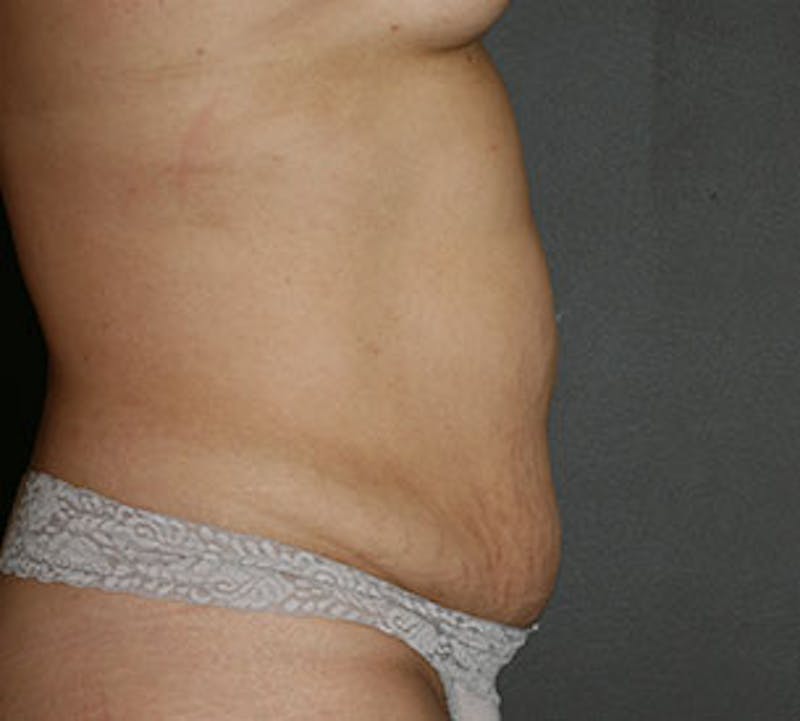 Abdominoplasty (Tummy Tuck) Gallery - Patient 106984934 - Image 9