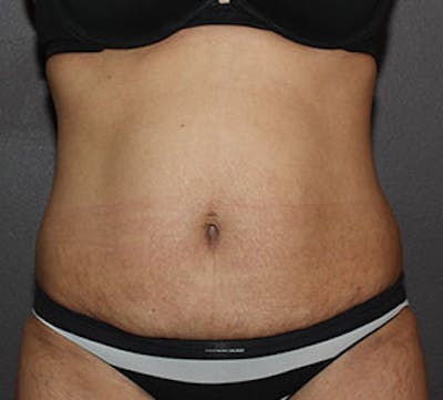 Abdominoplasty (Tummy Tuck) Before & After Gallery - Patient 106984941 - Image 1