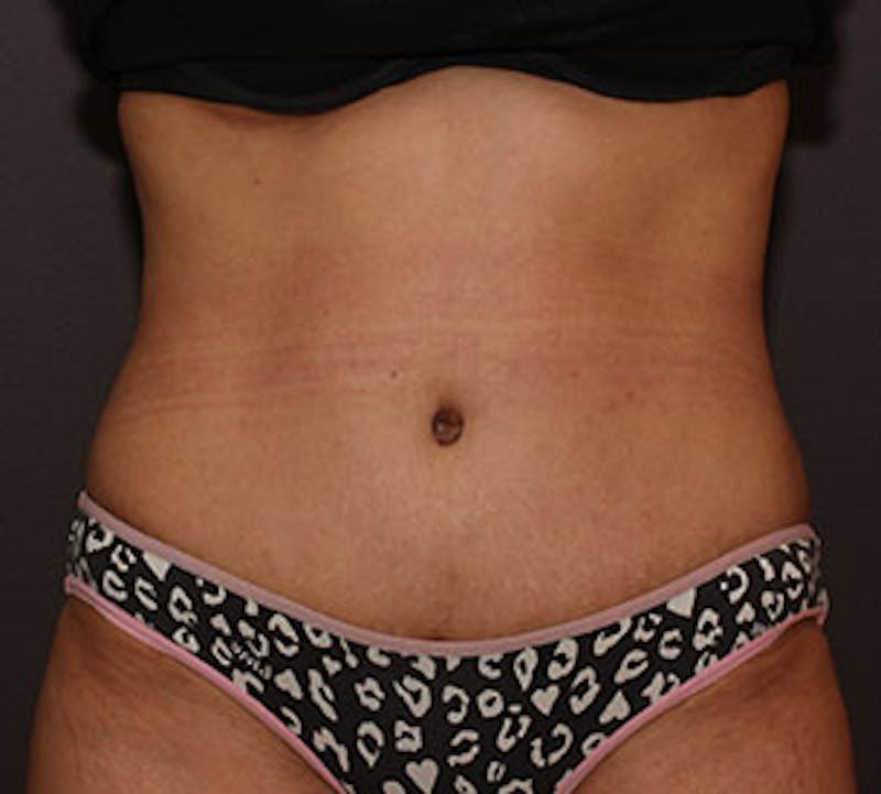 Abdominoplasty (Tummy Tuck) Before & After Gallery - Patient 106984941 - Image 2