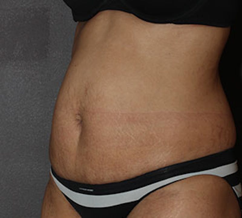 Abdominoplasty (Tummy Tuck) Before & After Gallery - Patient 106984941 - Image 3