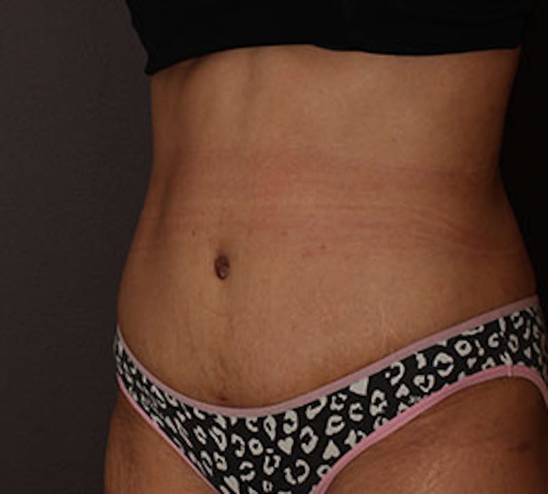 Abdominoplasty (Tummy Tuck) Before & After Gallery - Patient 106984941 - Image 4