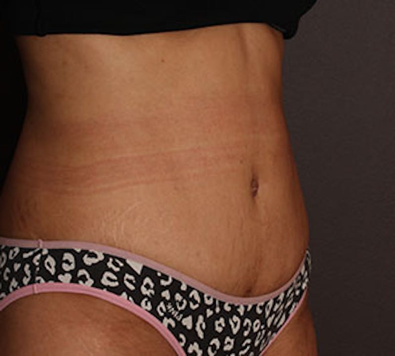 Abdominoplasty (Tummy Tuck) Before & After Gallery - Patient 106984941 - Image 6