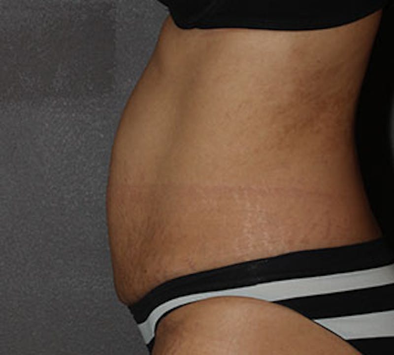 Abdominoplasty (Tummy Tuck) Before & After Gallery - Patient 106984941 - Image 7