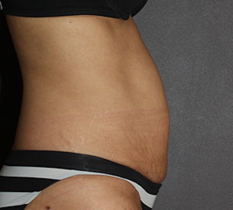 Abdominoplasty (Tummy Tuck) Before & After Gallery - Patient 106984941 - Image 9