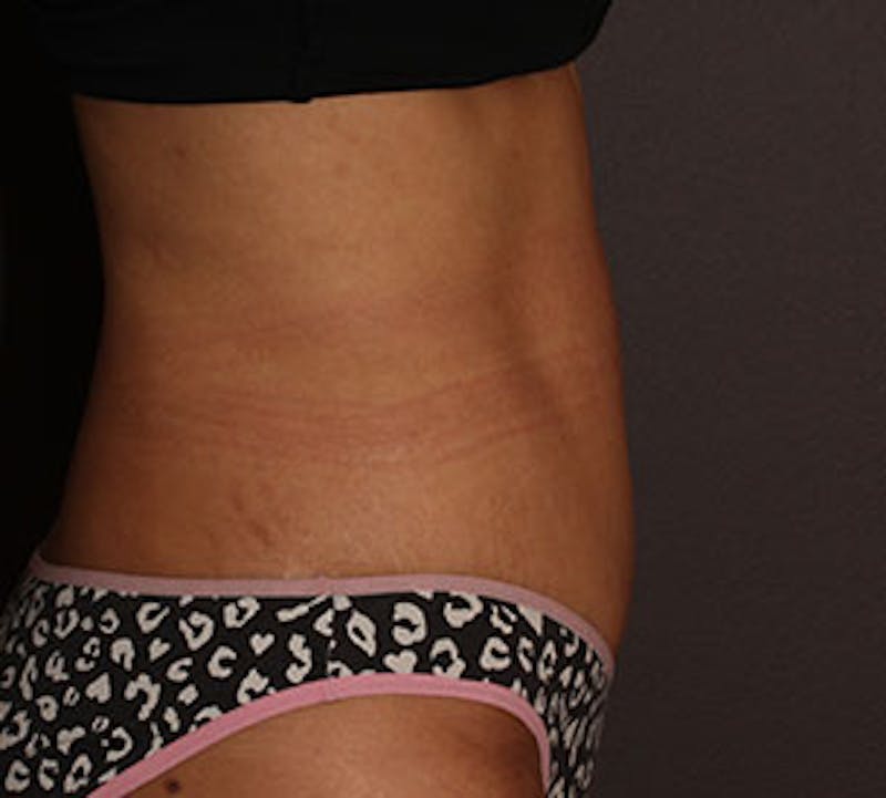 Abdominoplasty (Tummy Tuck) Before & After Gallery - Patient 106984941 - Image 10