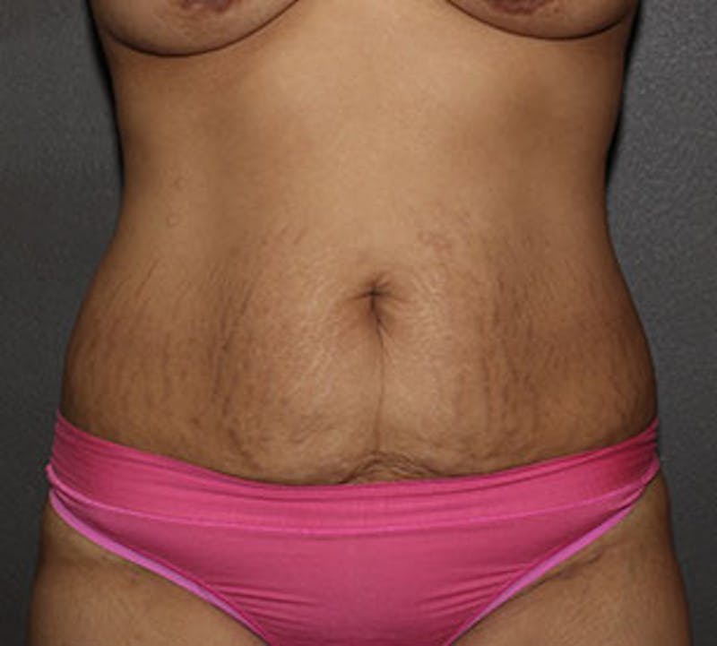 Abdominoplasty (Tummy Tuck) Gallery - Patient 106984953 - Image 1