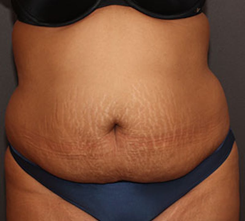 Abdominoplasty (Tummy Tuck) Before & After Gallery - Patient 106984960 - Image 1