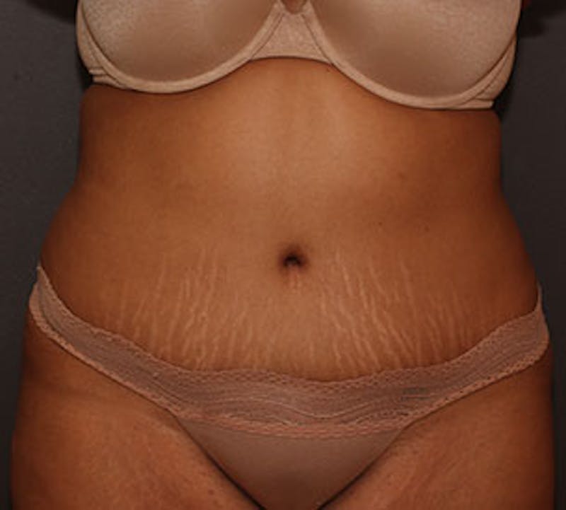 Abdominoplasty (Tummy Tuck) Before & After Gallery - Patient 106984960 - Image 2