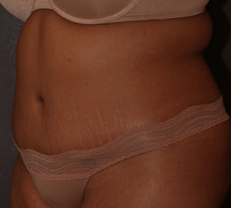 Abdominoplasty (Tummy Tuck) Before & After Gallery - Patient 106984960 - Image 4