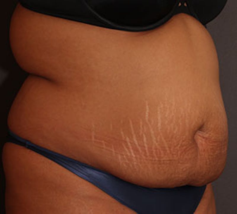 Abdominoplasty (Tummy Tuck) Before & After Gallery - Patient 106984960 - Image 5