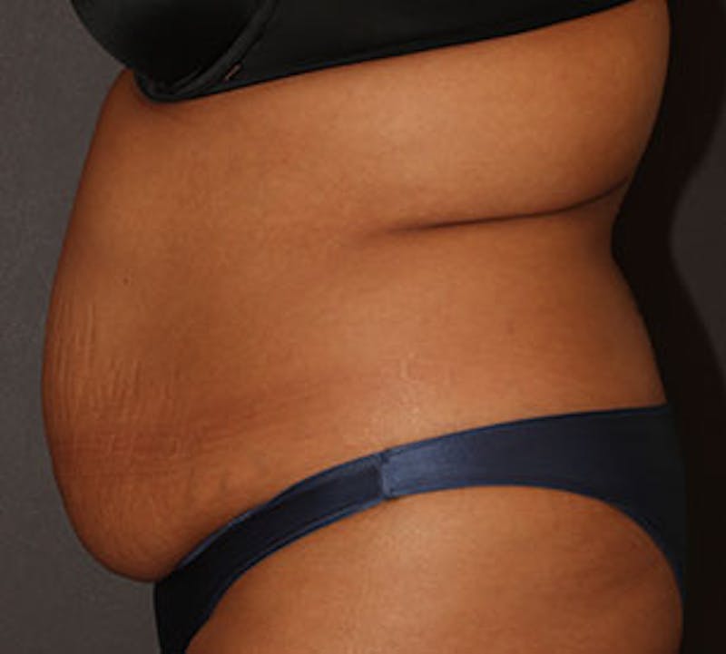 Abdominoplasty (Tummy Tuck) Before & After Gallery - Patient 106984960 - Image 7