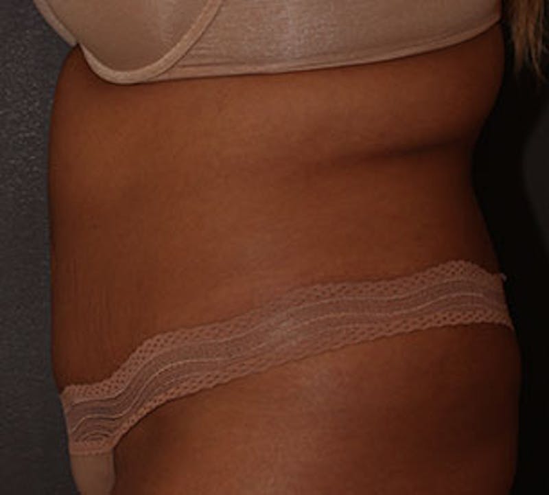 Abdominoplasty (Tummy Tuck) Before & After Gallery - Patient 106984960 - Image 8