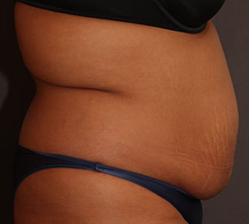 Abdominoplasty (Tummy Tuck) Before & After Gallery - Patient 106984960 - Image 9