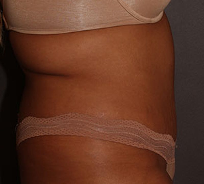 Abdominoplasty (Tummy Tuck) Before & After Gallery - Patient 106984960 - Image 10