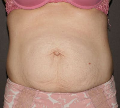 Abdominoplasty (Tummy Tuck) Before & After Gallery - Patient 106984976 - Image 1