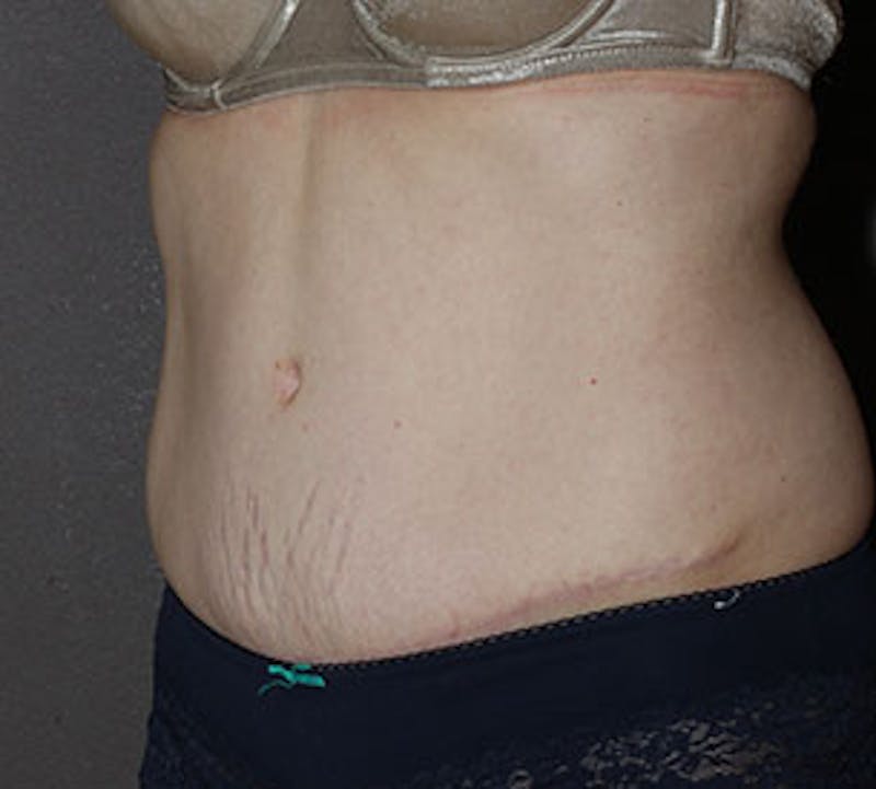Abdominoplasty (Tummy Tuck) Before & After Gallery - Patient 106984976 - Image 4
