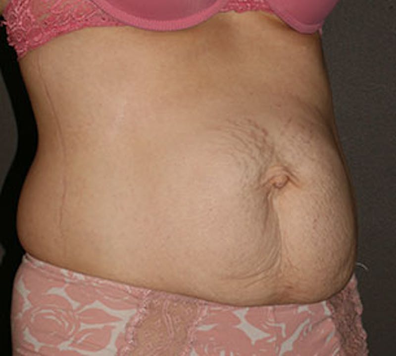 Abdominoplasty (Tummy Tuck) Before & After Gallery - Patient 106984976 - Image 5