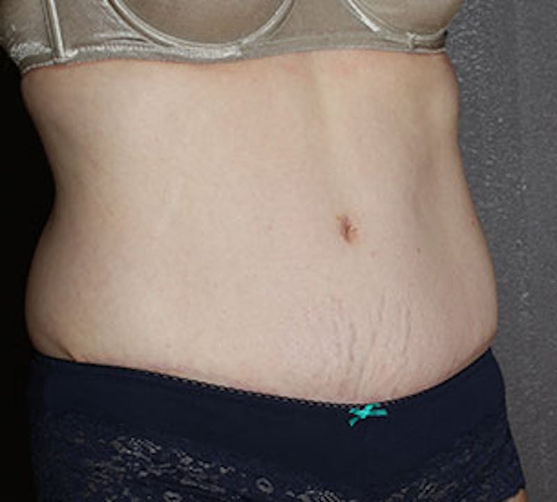 Abdominoplasty (Tummy Tuck) Before & After Gallery - Patient 106984976 - Image 6