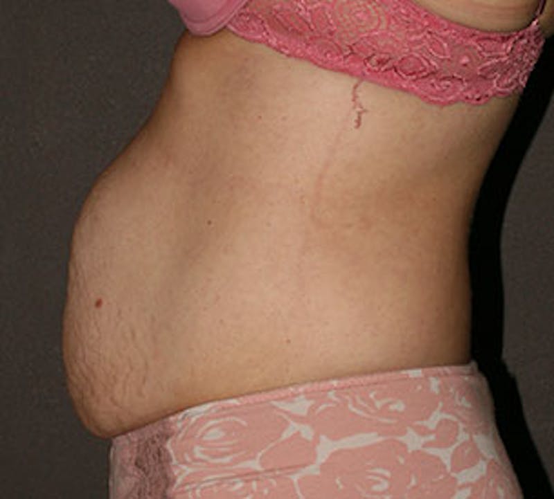 Abdominoplasty (Tummy Tuck) Before & After Gallery - Patient 106984976 - Image 7