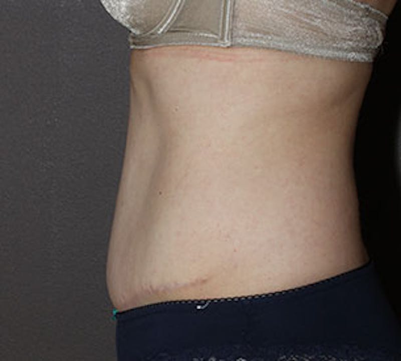 Abdominoplasty (Tummy Tuck) Before & After Gallery - Patient 106984976 - Image 8