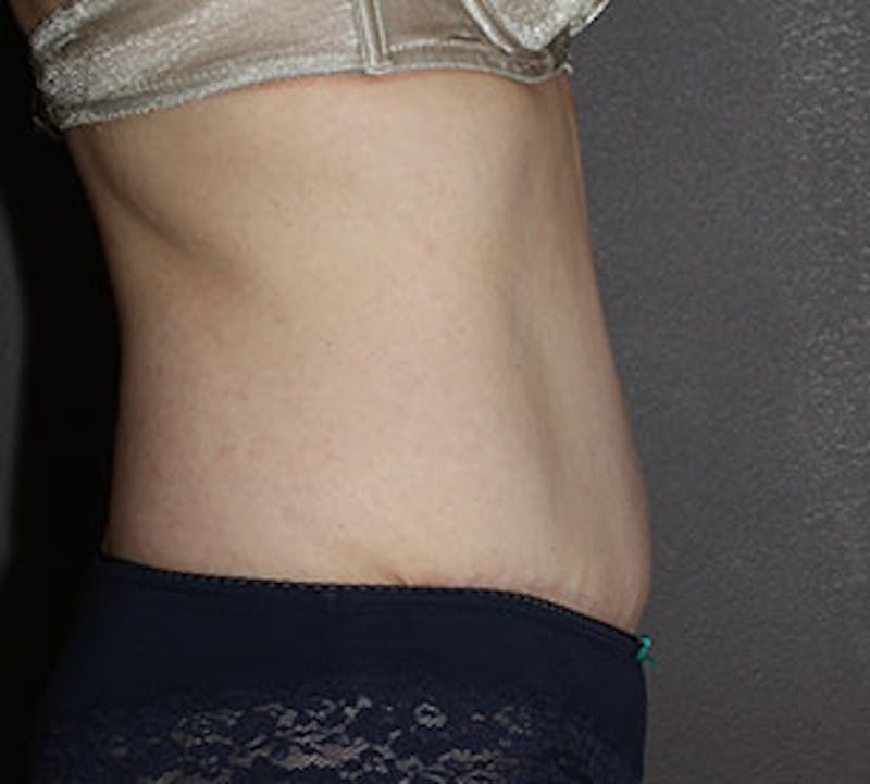 Abdominoplasty (Tummy Tuck) Before & After Gallery - Patient 106984976 - Image 10