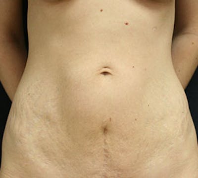 Abdominoplasty (Tummy Tuck) Before & After Gallery - Patient 106984985 - Image 1