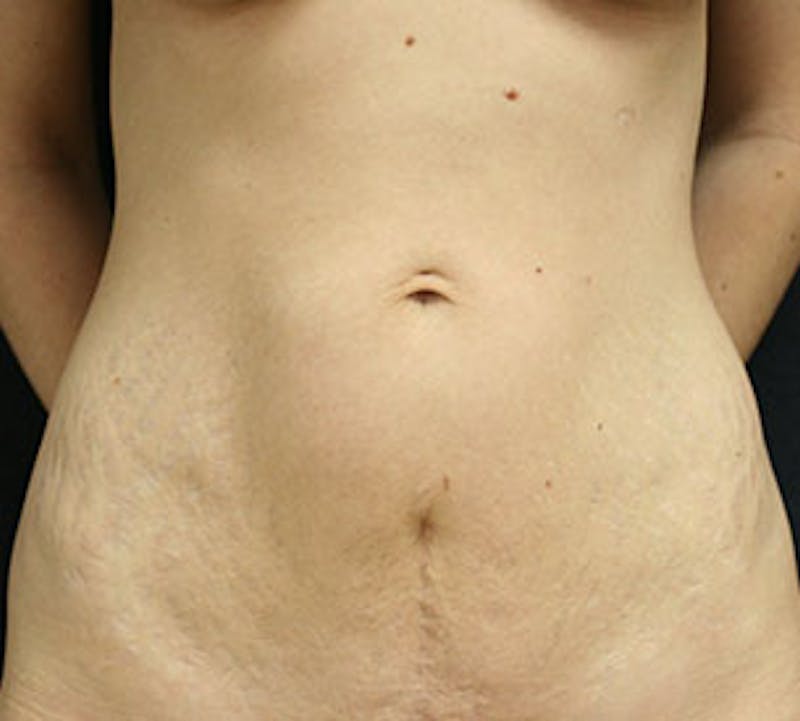 Abdominoplasty (Tummy Tuck) Gallery - Patient 106984985 - Image 1