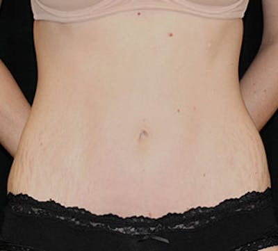 Abdominoplasty (Tummy Tuck) Before & After Gallery - Patient 106984985 - Image 2