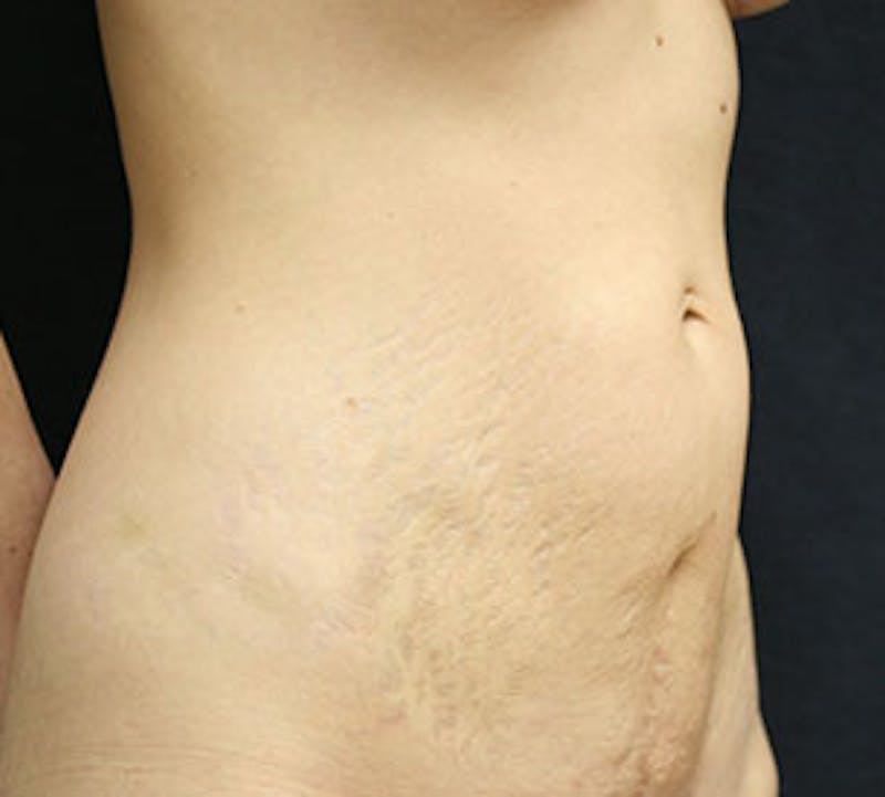 Abdominoplasty (Tummy Tuck) Before & After Gallery - Patient 106984985 - Image 3