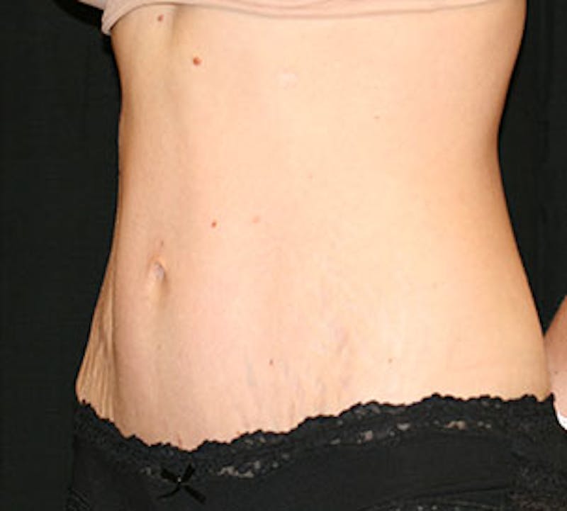 Abdominoplasty (Tummy Tuck) Before & After Gallery - Patient 106984985 - Image 6