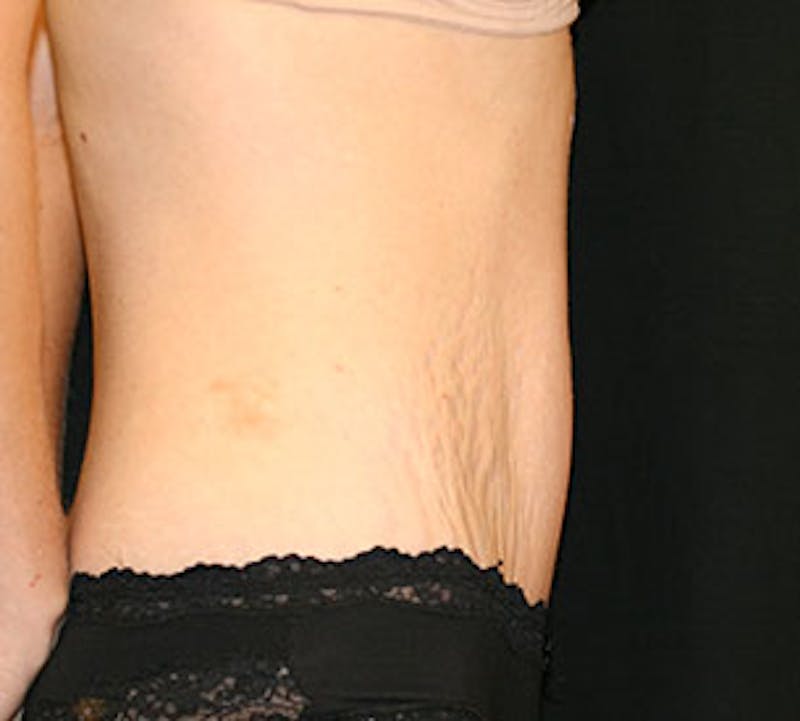 Abdominoplasty (Tummy Tuck) Before & After Gallery - Patient 106984985 - Image 8