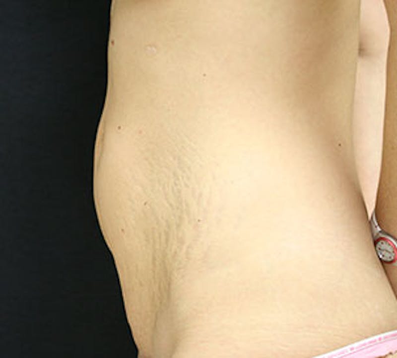 Abdominoplasty (Tummy Tuck) Gallery - Patient 106984985 - Image 9